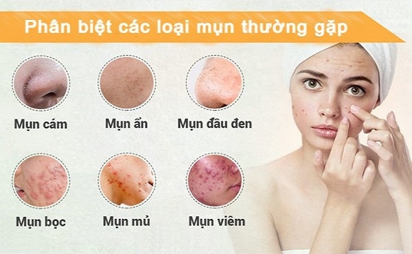 Các loại mụn phổ biến hiện nay